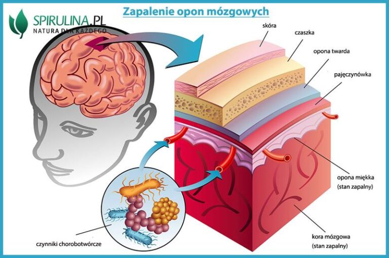 Jak rozpoznać zapalenie opon mózgowych u niemowląt – objawy, na które warto zwrócić uwagę